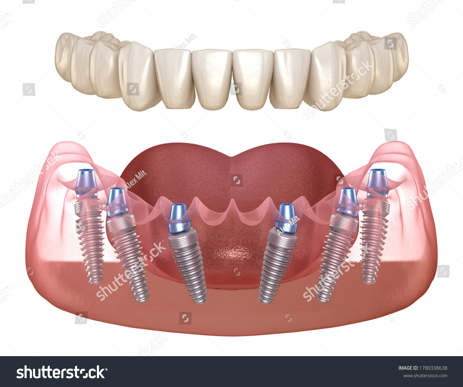 Mandibular Prosthesis Gum All On 6 Stock Illustration 1780338638 ...