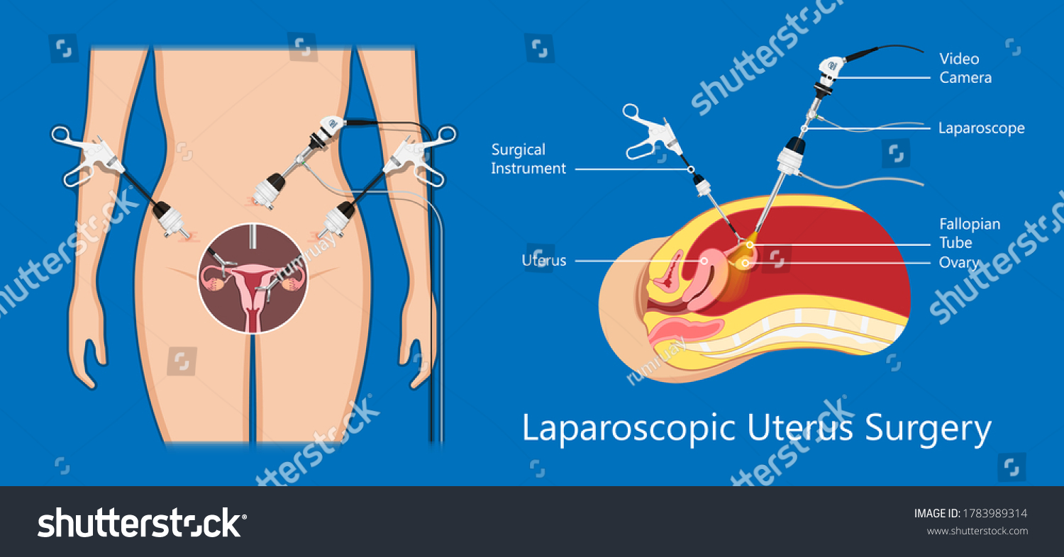 Laparoscopic Hysterectomy Medical Surgical Treat Cervix Stock Vector Royalty Free 1783989314 1421