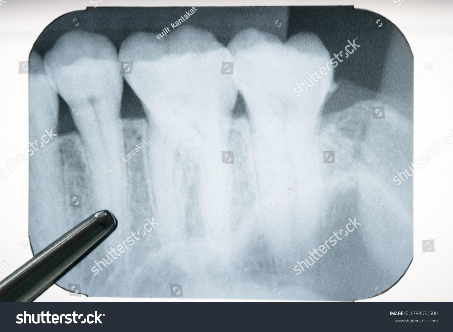 Panoramic Dental Xray Mouth Stock Photo 1788570500 | Shutterstock