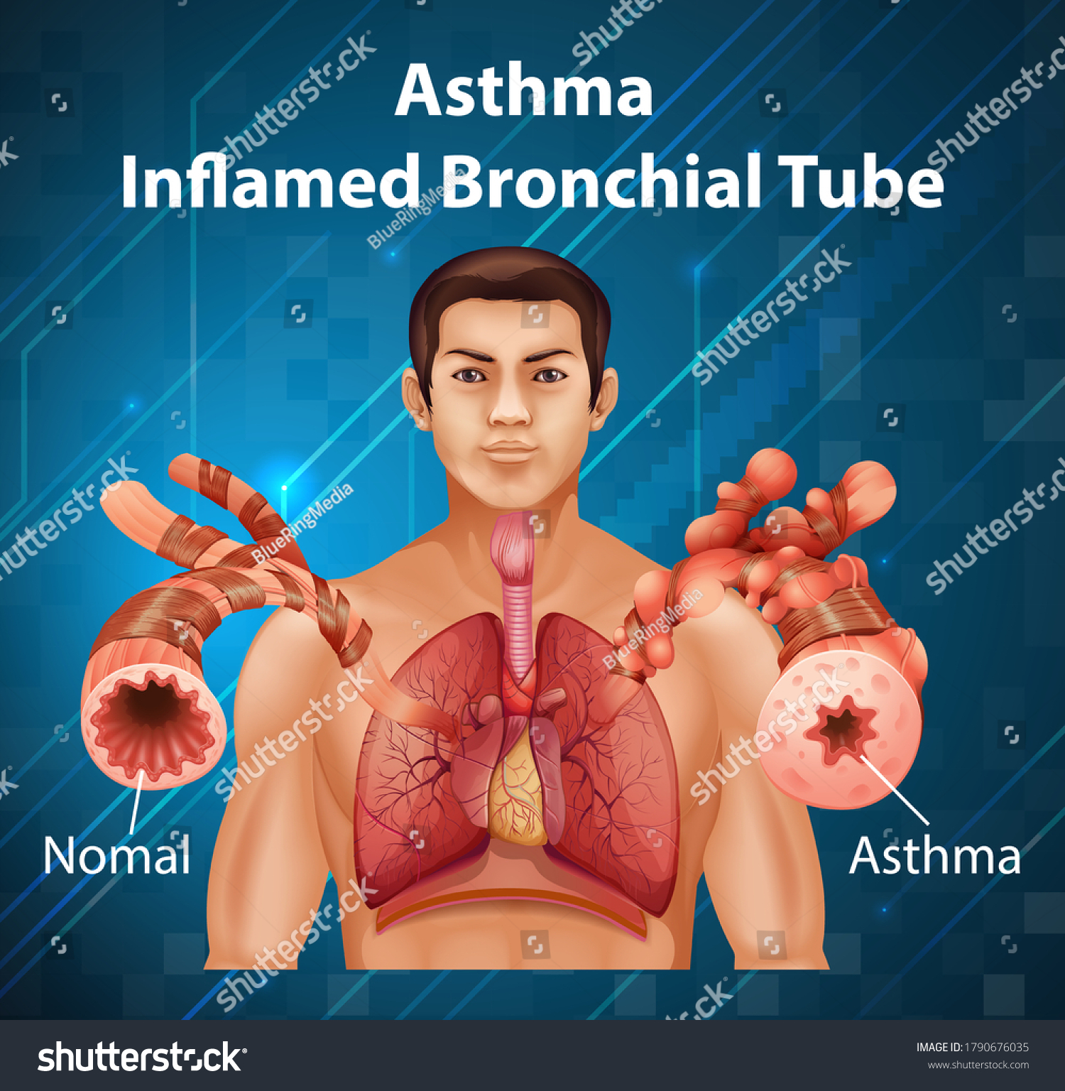 Human Anatomy Asthma Inflamed Bronchial Tube Stock Vector Royalty Free