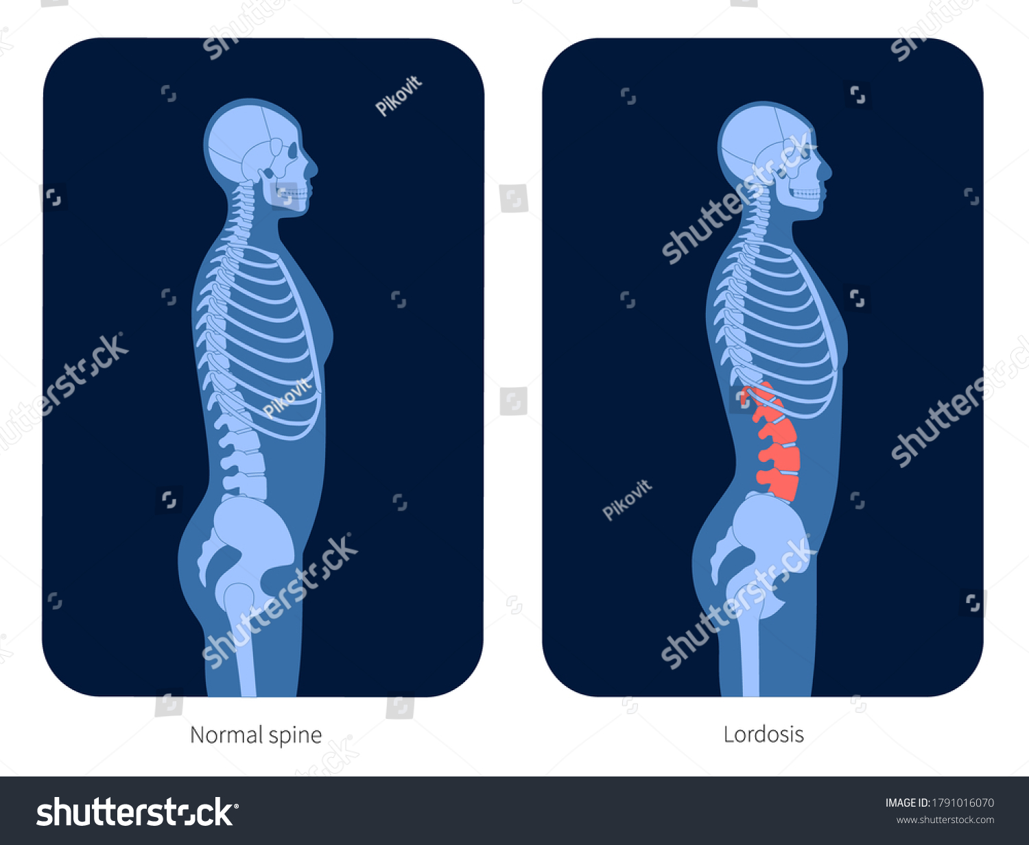 Normal Spine Lordosis Man Body Xray Stock Vector (Royalty Free ...