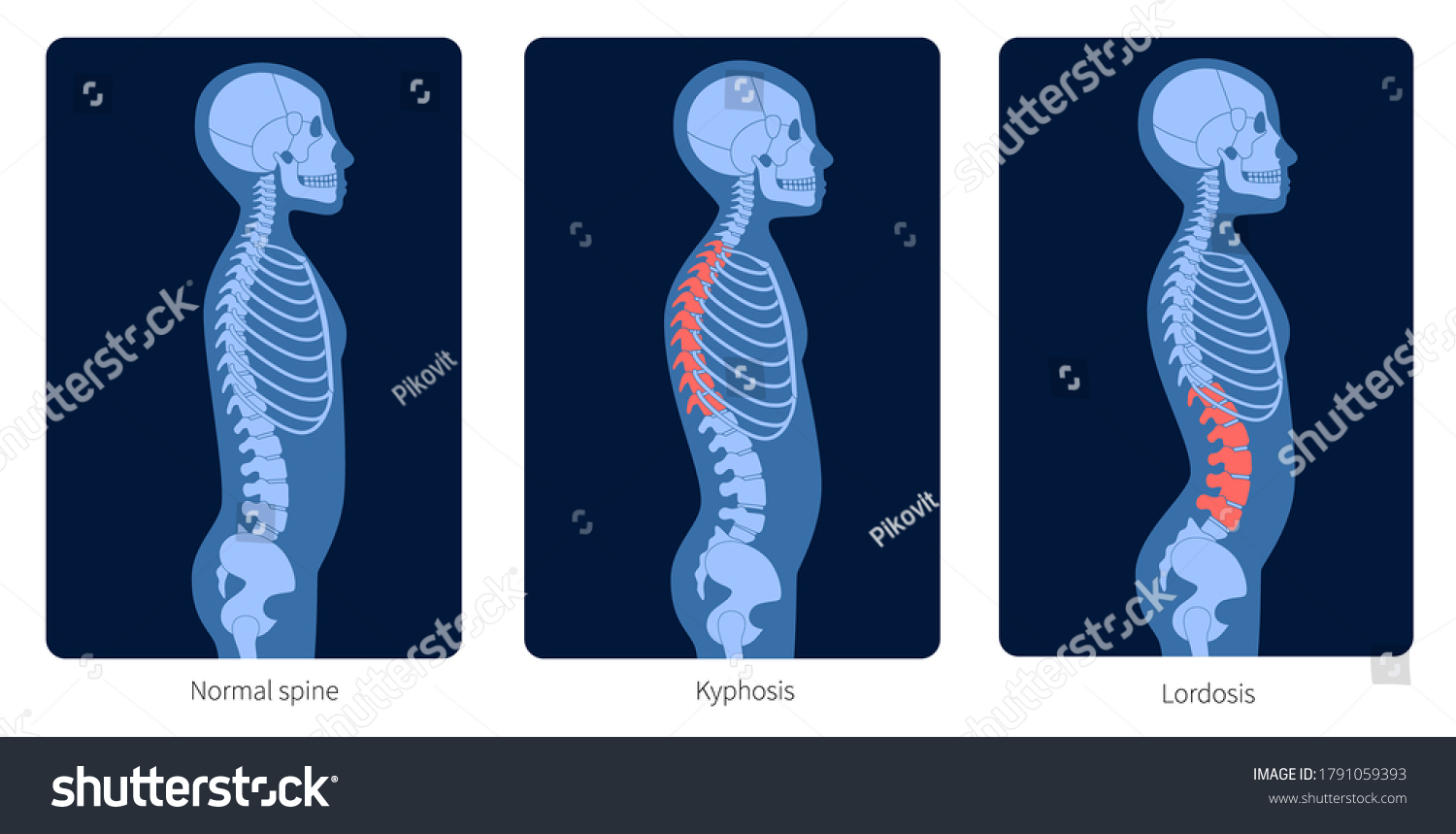 normal-spine-lordosis-kyphosis-scoliosis-child-1791059393