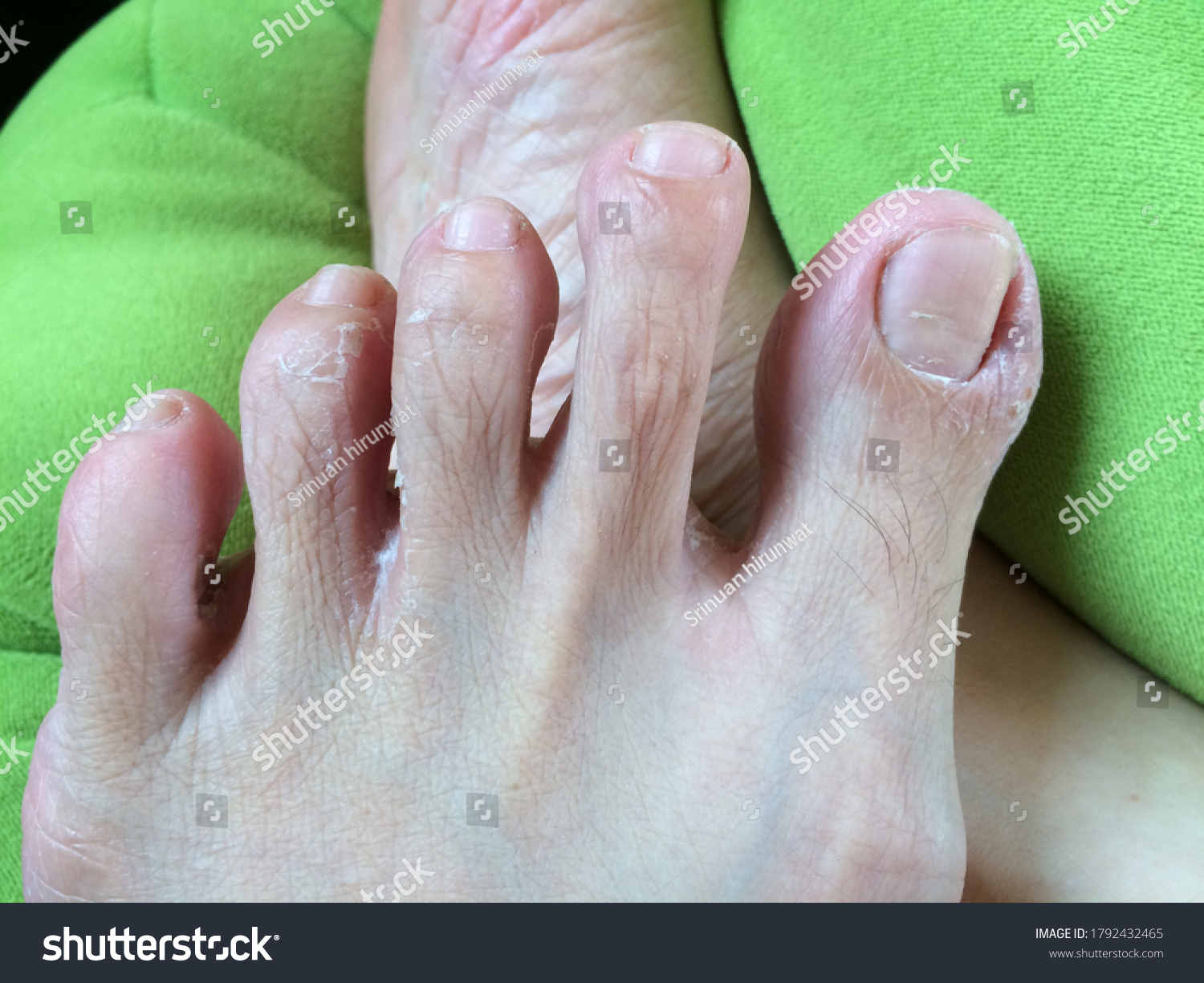 peeling-skin-rash-on-feet-must-stock-photo-1792432465-shutterstock