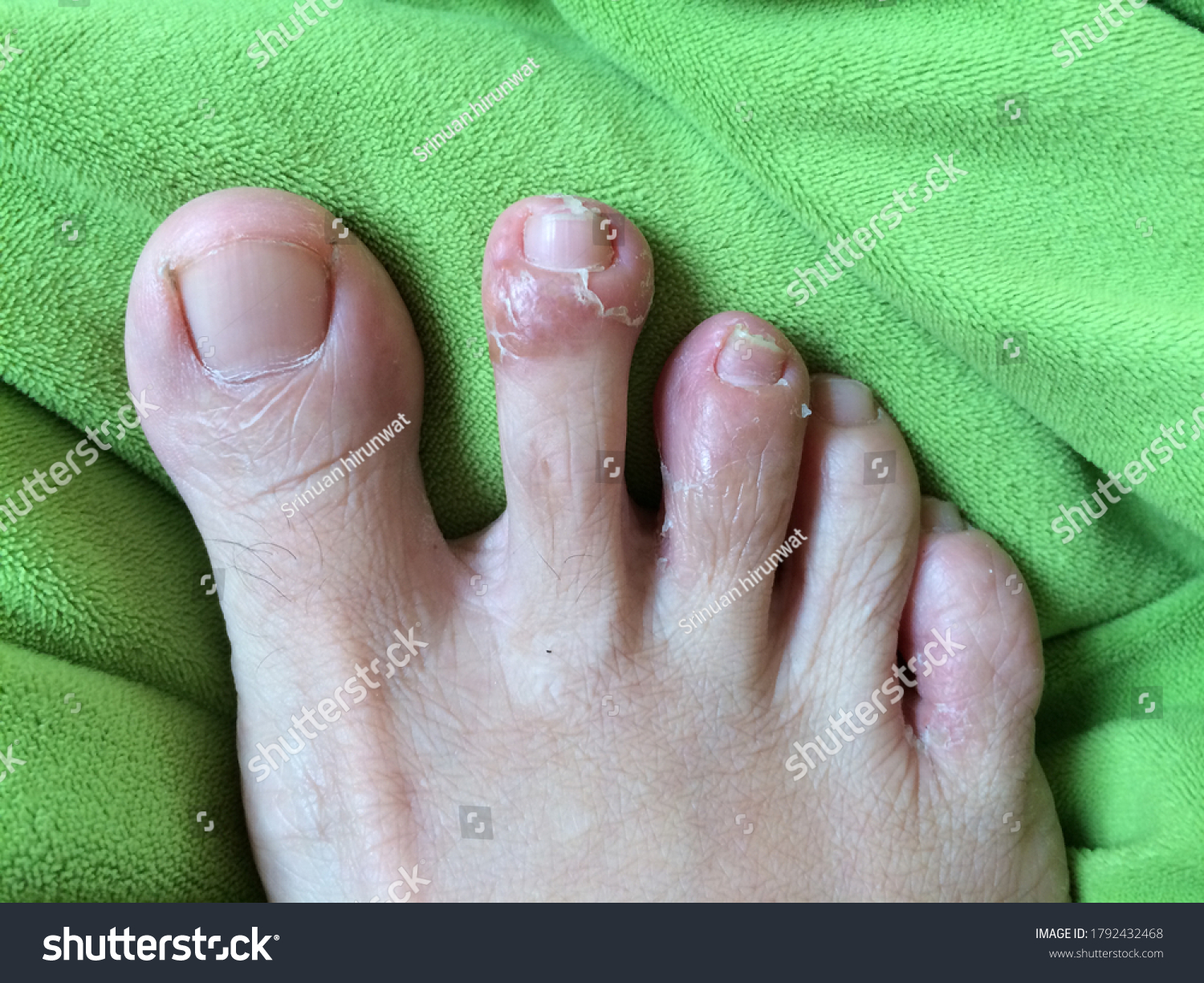 peeling-skin-rash-on-feet-must-stock-photo-1792432468-shutterstock