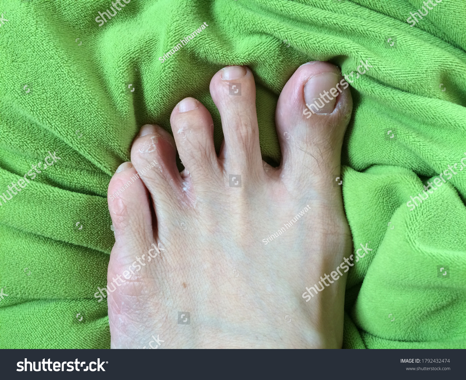 peeling-skin-rash-on-feet-must-stock-photo-1792432474-shutterstock