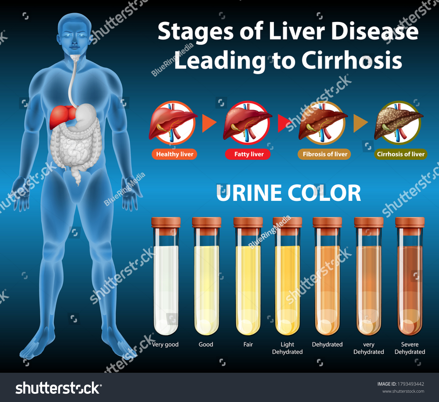 Stages Liver Disease Illustration Stock Vector (Royalty Free ...