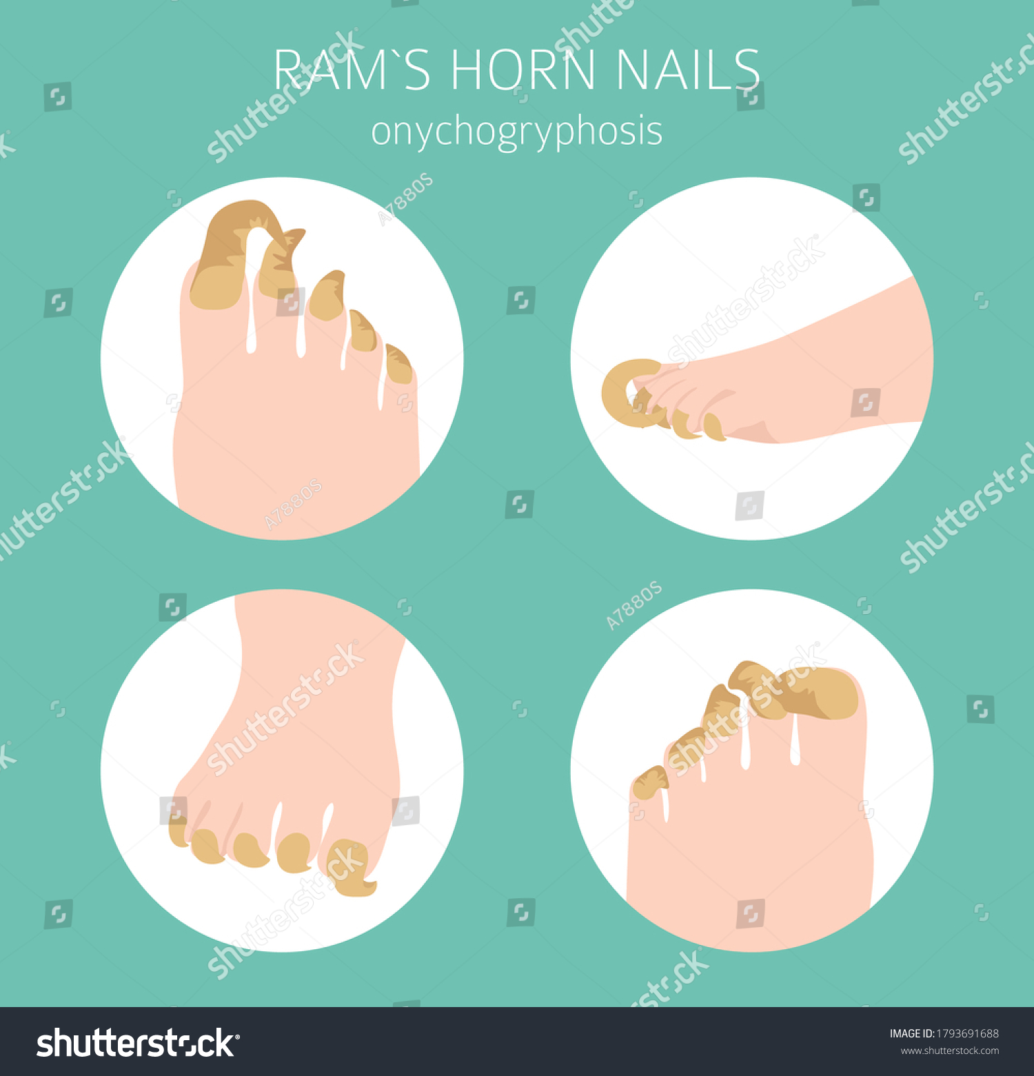 Nail Diseases Onychogryphosis Rams Horn Nail Stock Vector (Royalty Free ...