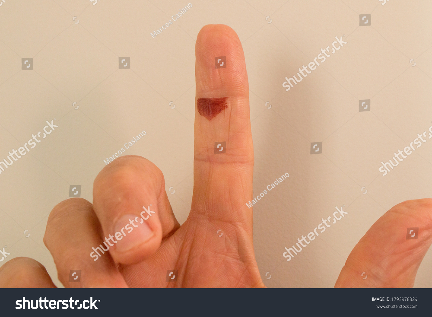 blood-blister-on-index-finger-stock-photo-1793978329-shutterstock