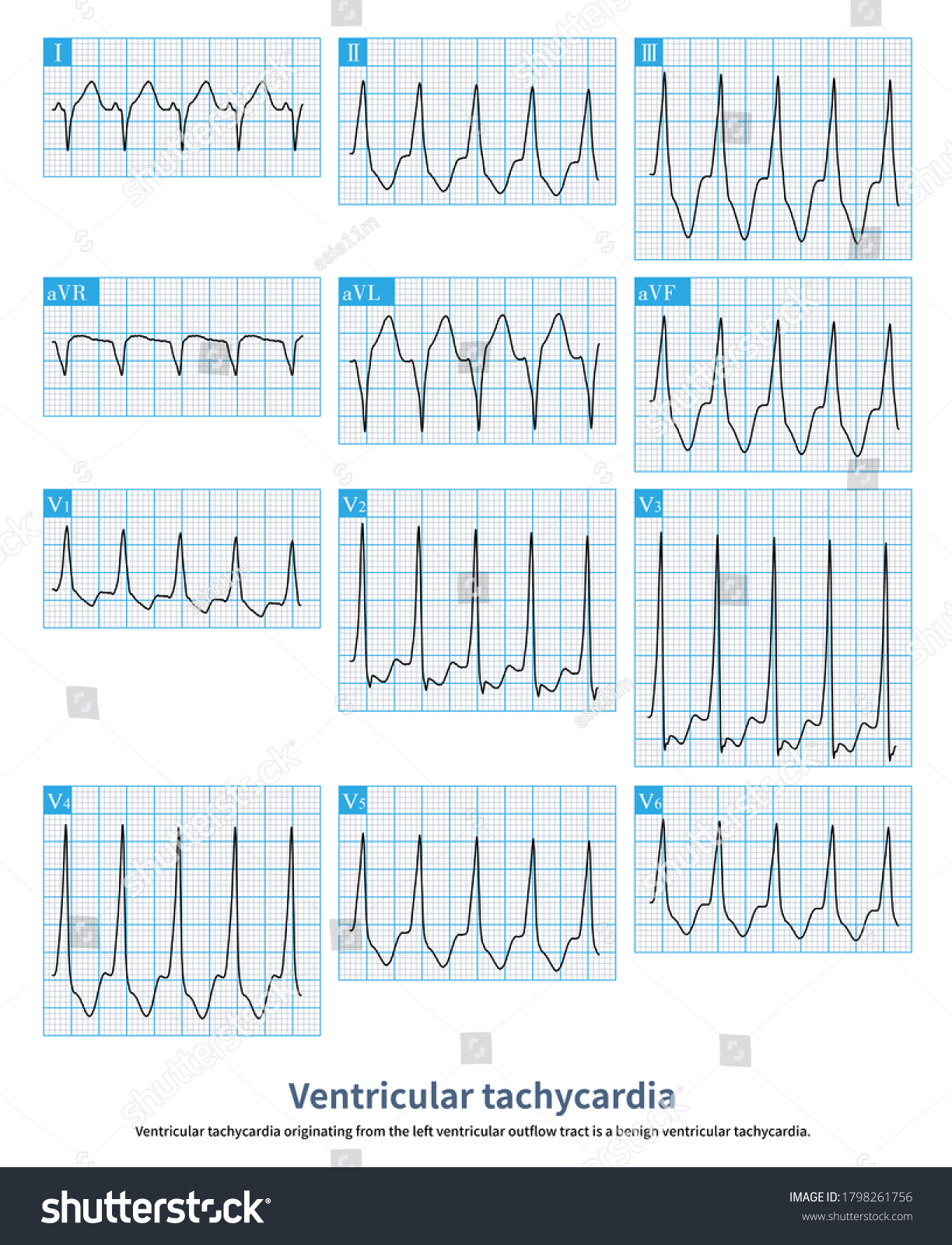 Ventricular Tachycardia Originating Left Ventricular Outflow Stock ...