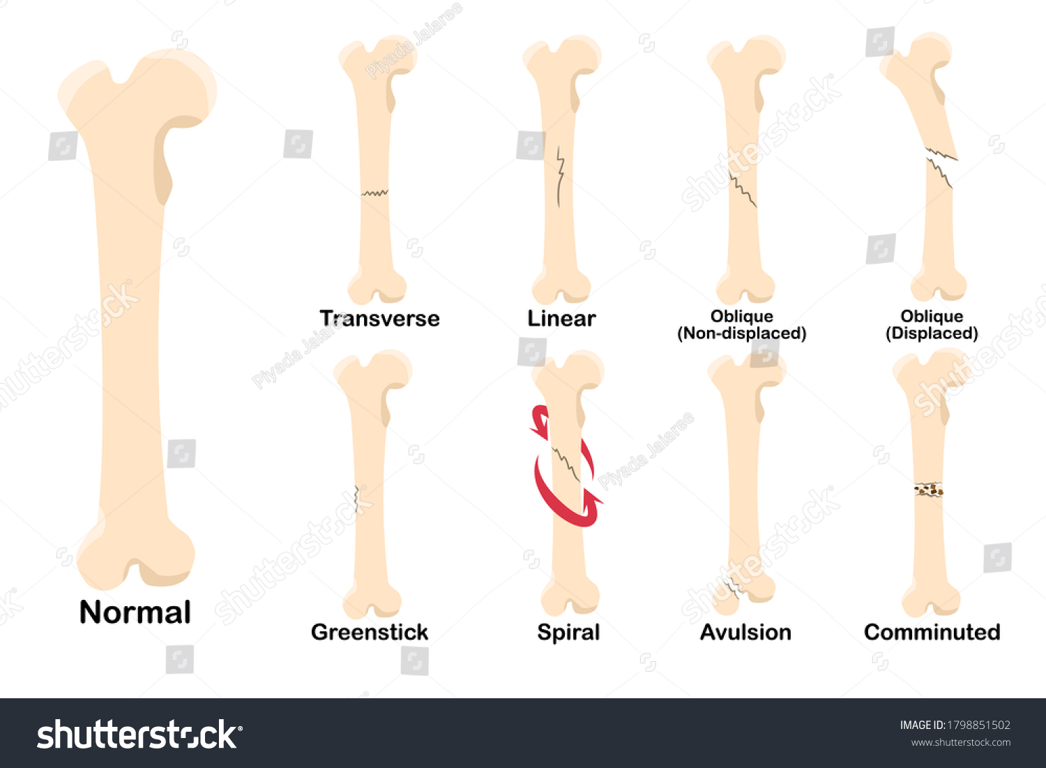 Type Fracture Medical Theme Orthopedics Condition Stock Vector (Royalty ...