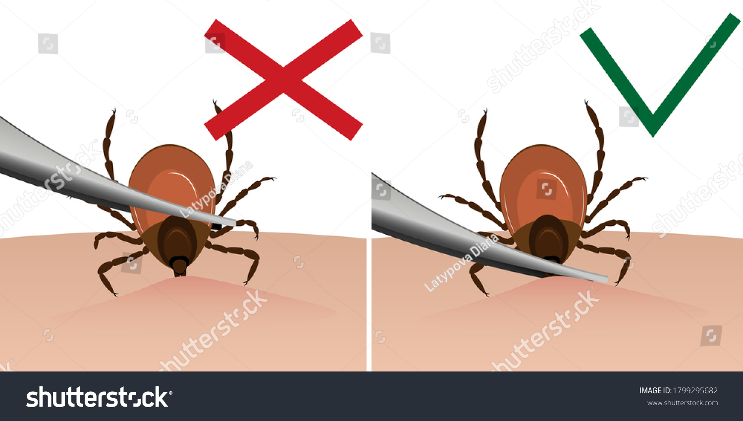 754 Tick Tweezers Images Stock Photos Vectors Shutterstock   Stock Photo A Tick Is Removed From The Skin With Tweezers Tick Bite 1799295682 