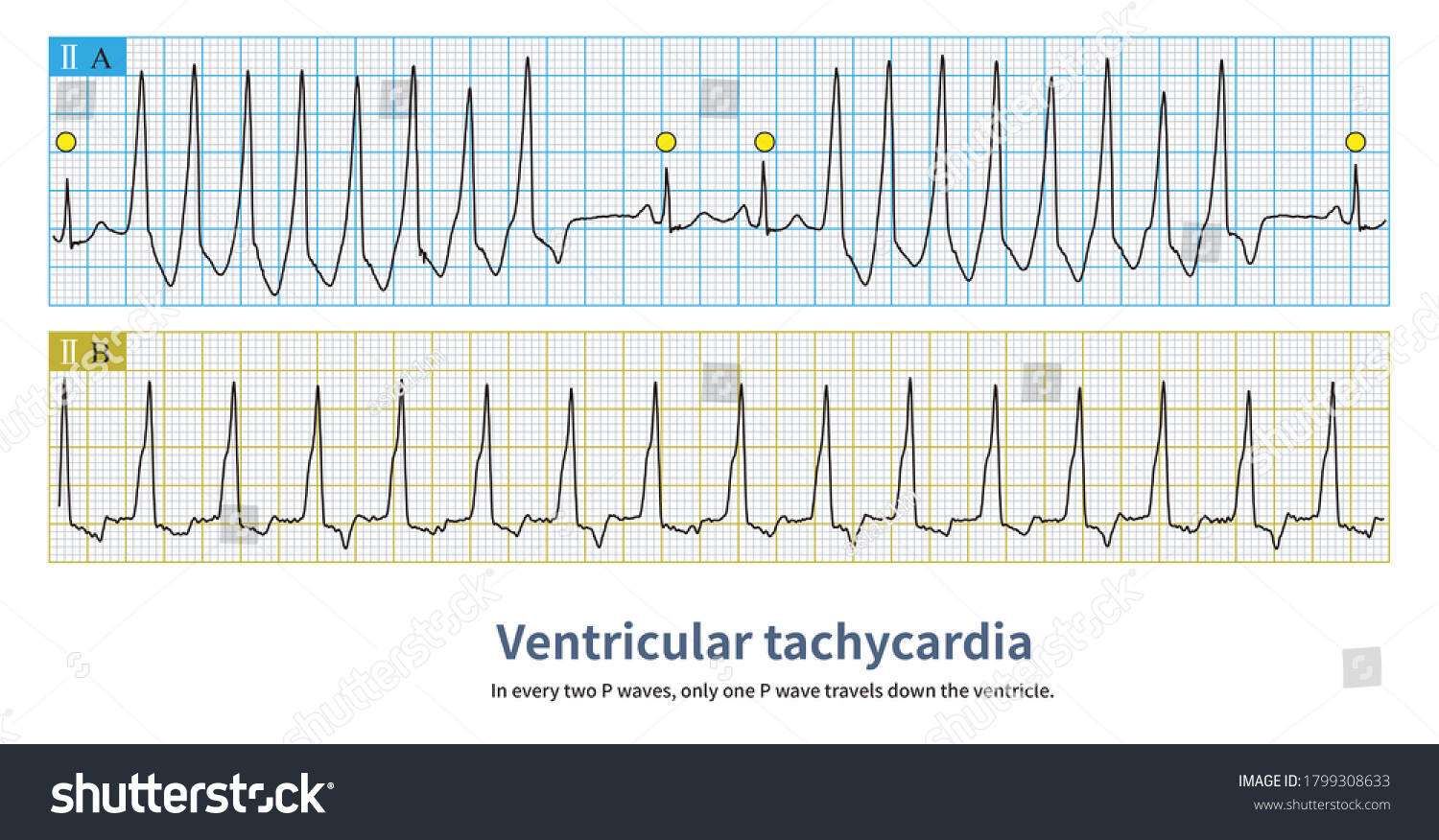 Endless Pattern Ventricular Tachycardia Yellow Circle Stock ...