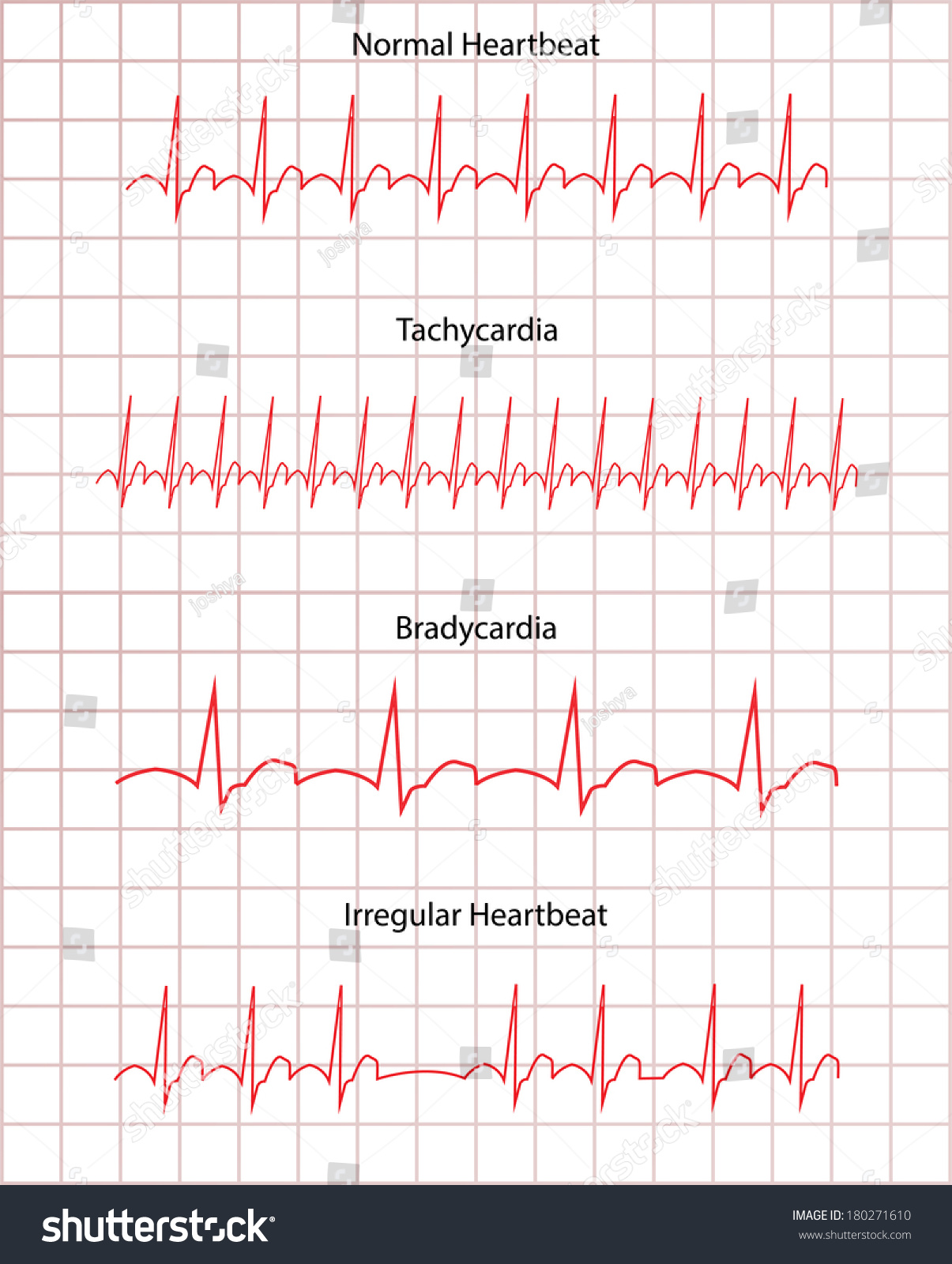 Ecg Pathology Disease Stock Illustration 180271610 | Shutterstock