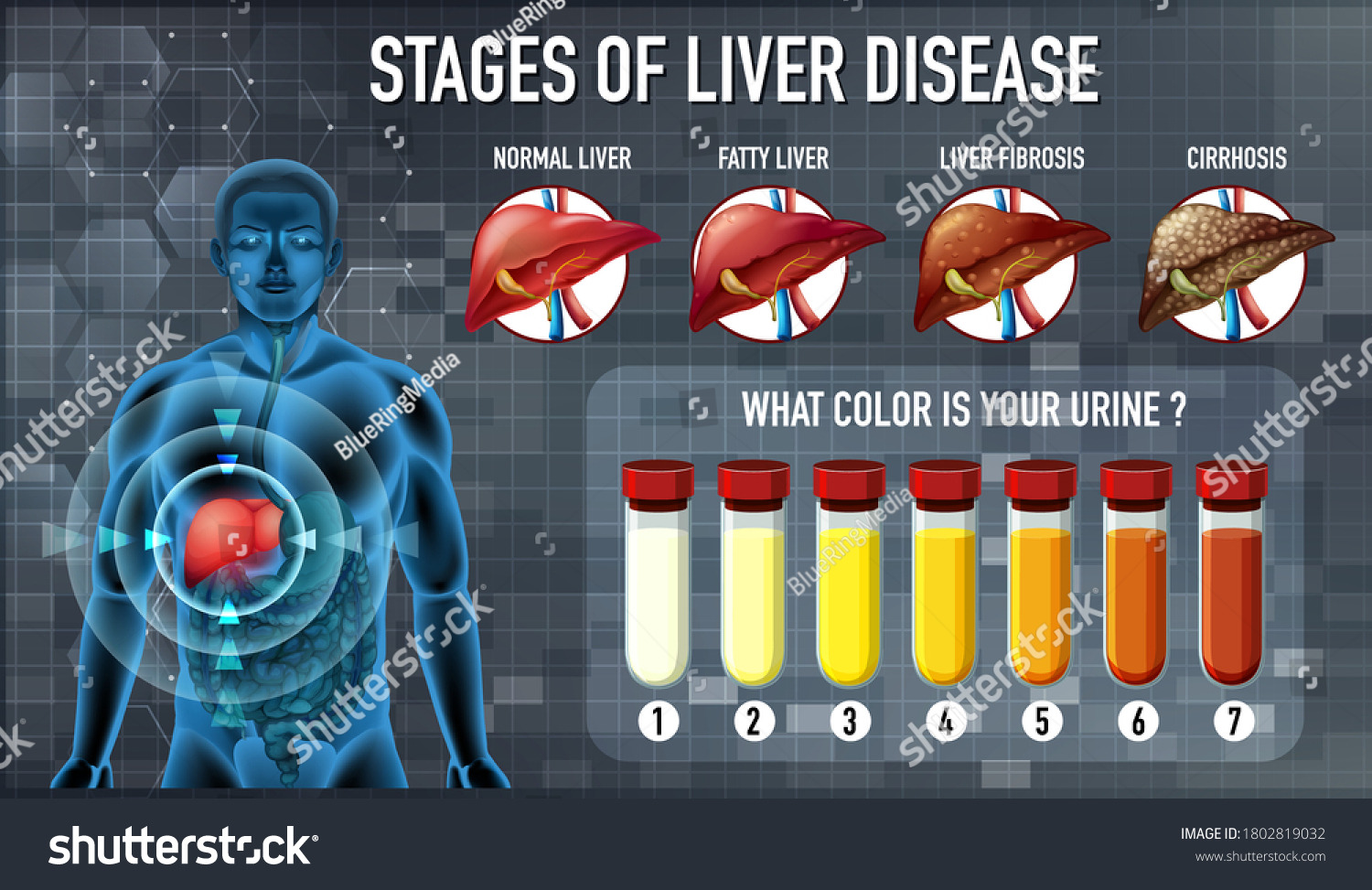 Stages Liver Disease Illustration Stock Vector (Royalty Free ...