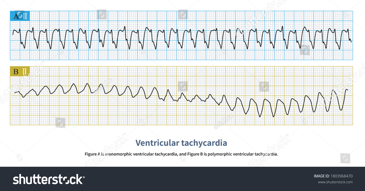 Figure Monomorphic Ventricular Tachycardia Figure B Stock Illustration 