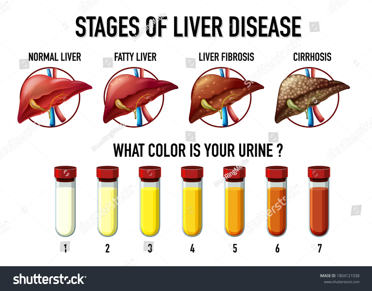 Stages Liver Disease Illustration Stock Vector (Royalty Free ...