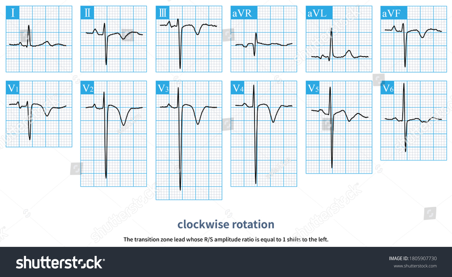 Electrocardiogram Patient Pulmonary Embolism Showed That Stock ...