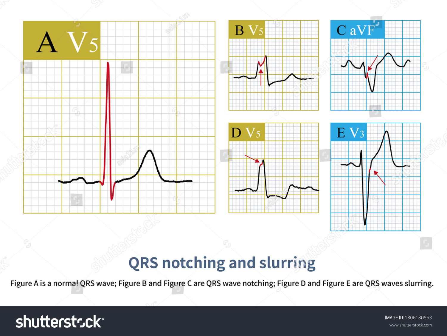 Ilustrasi Stok Normal Ventricular Depolarization Produces Smooth Sharp ...