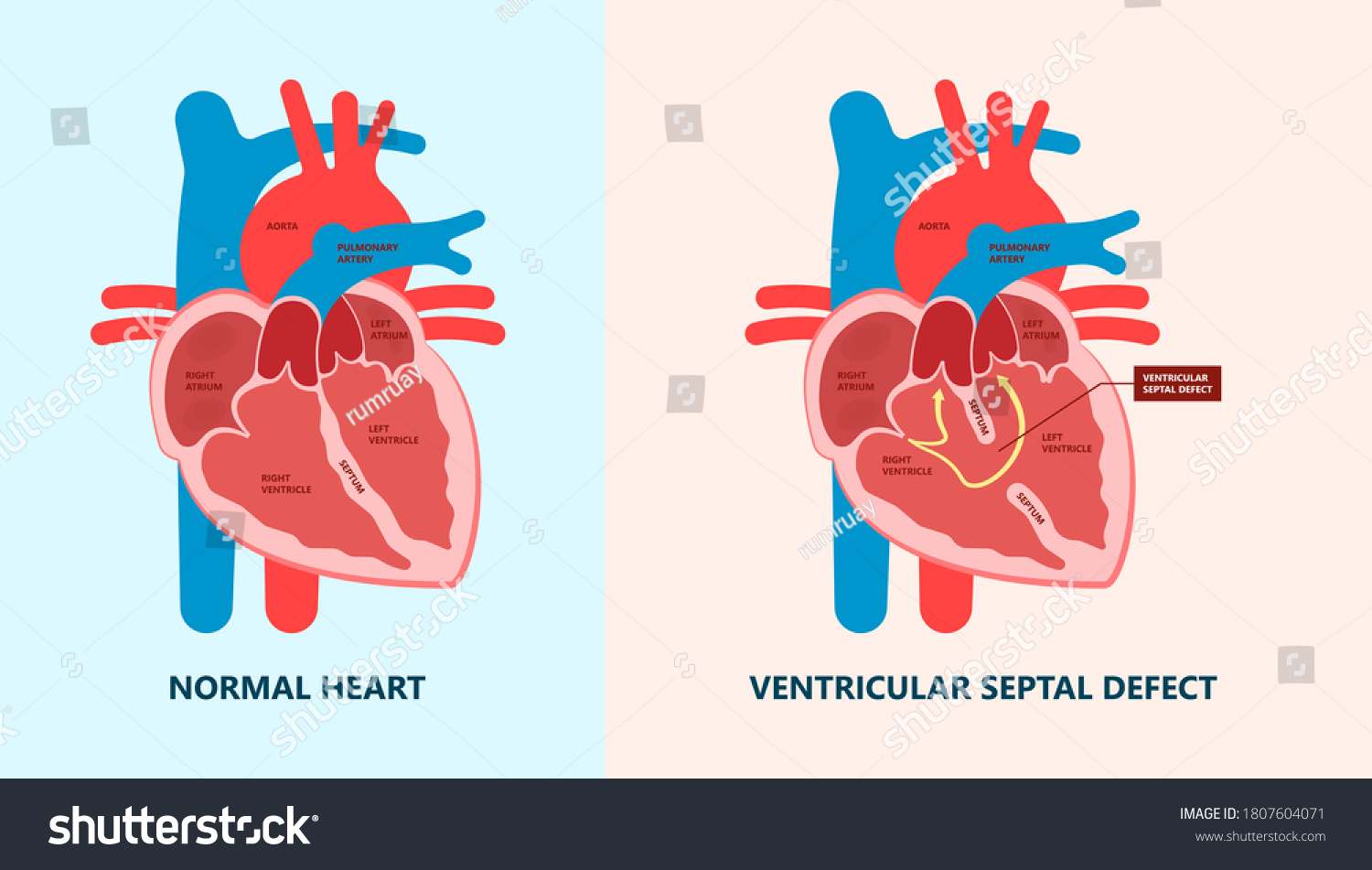 206 Ventricular septal defect Images, Stock Photos & Vectors | Shutterstock