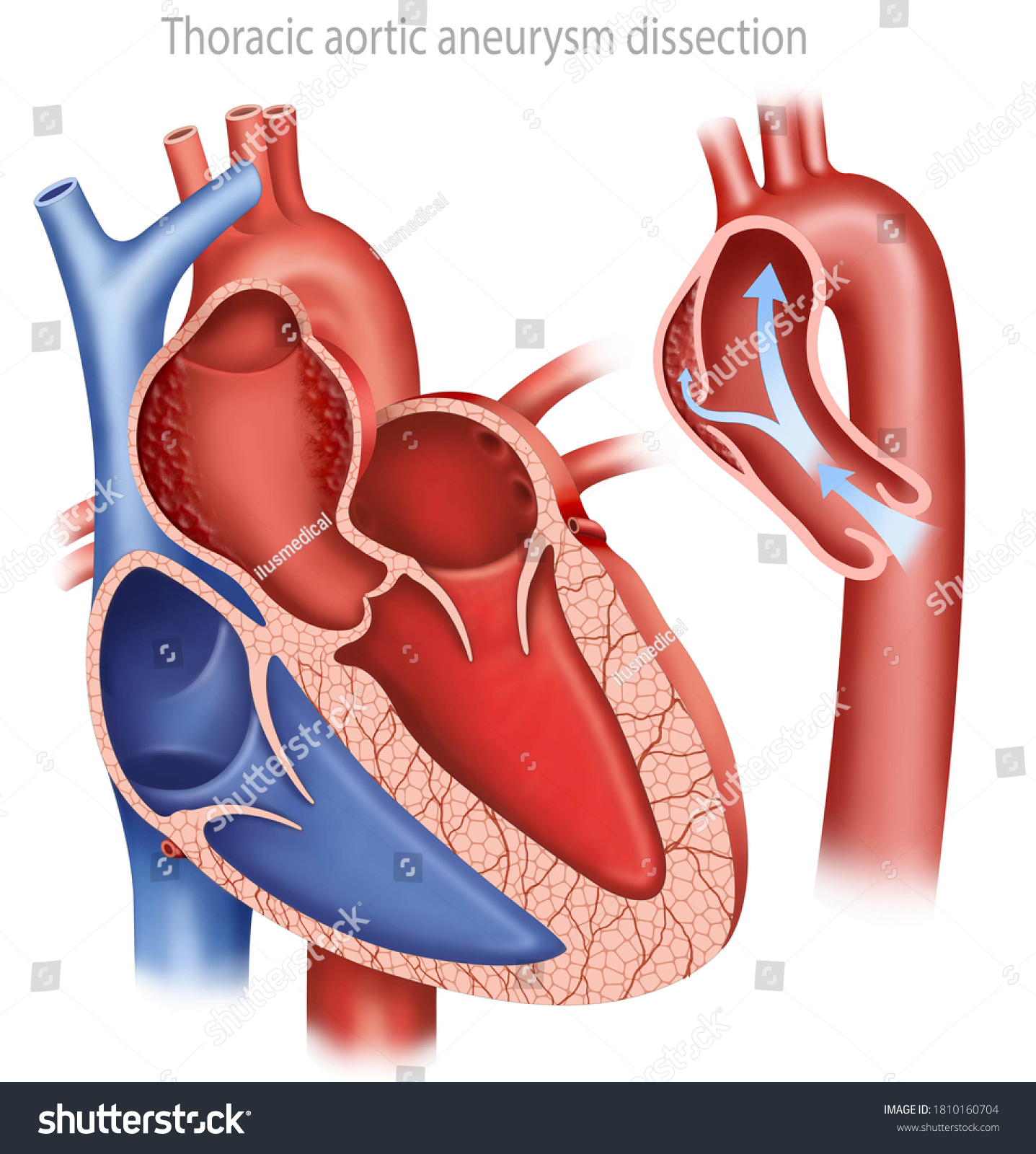 Aortic Aneurysm Descriptive Illustration Aneurysm Shows Stock ...