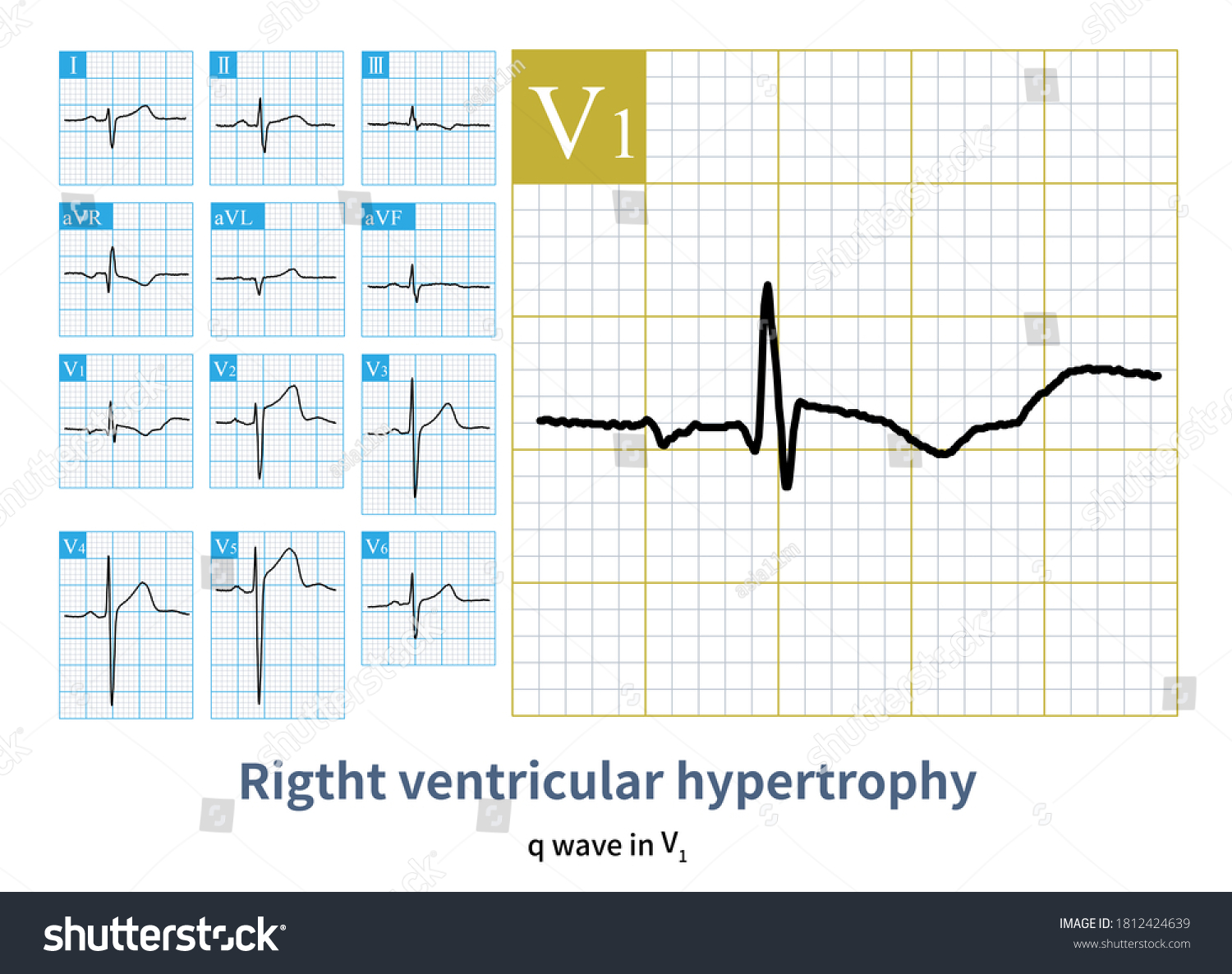 Electrocardiogram Patient Atrial Septal Defect Q Stock Illustration 