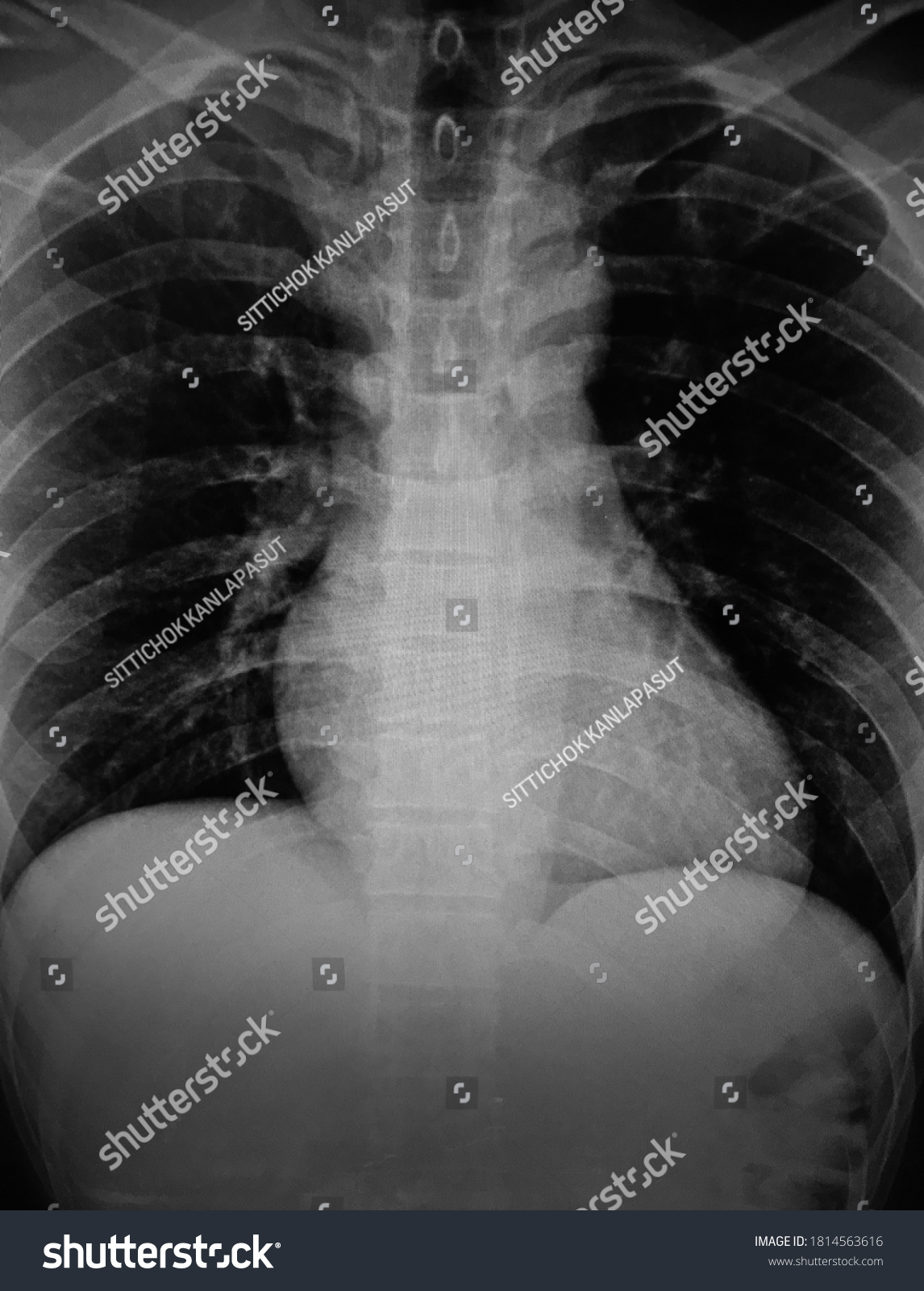 X Ray Chest Showing Lungs Heart Stock Photo 1814563616 | Shutterstock