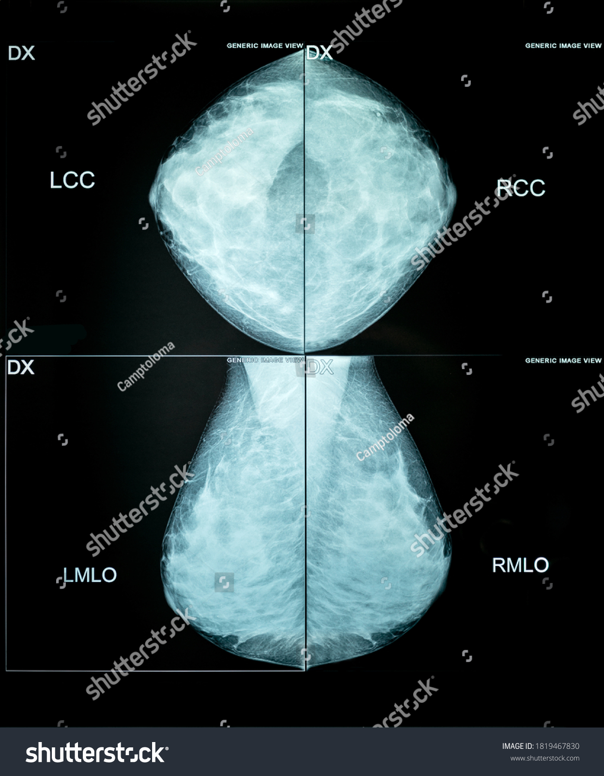 Xray Mammography Cancer Checking Breasts Ful Stock Photo 1819467830 ...