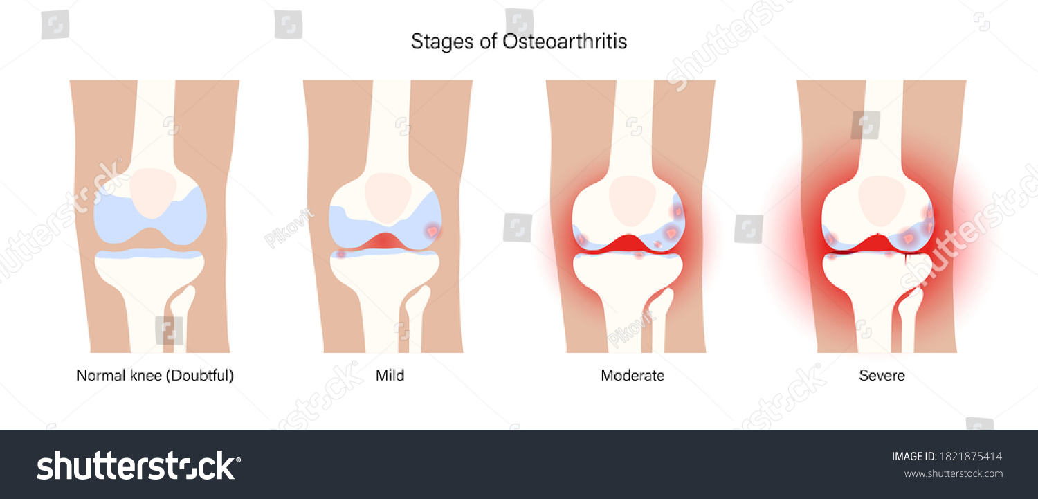 X Ray Stages Osteoarthritis Knee Joint Stock Vector (Royalty Free ...