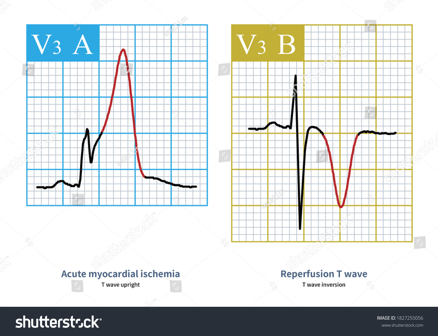 Reperfusion T Wave Can Be Seen Stock Illustration 1827255056 | Shutterstock