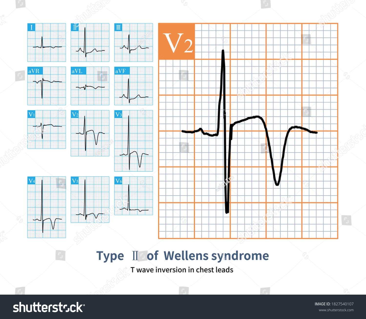 Electrocardiogram This Type Wellens Syndrome Characterized Stock ...