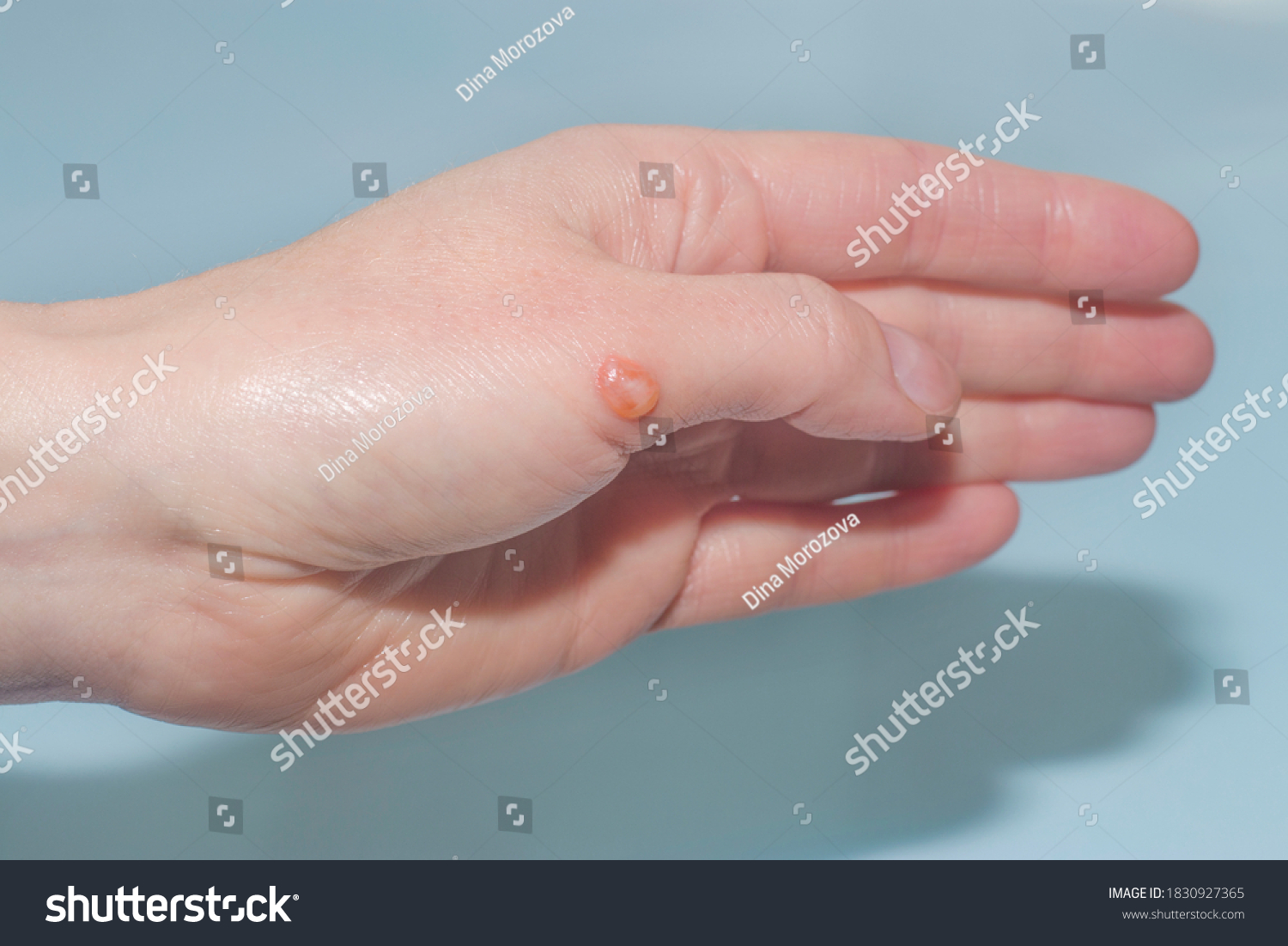 Blister On Hand After Burn Stock Photo 1830927365 Shutterstock