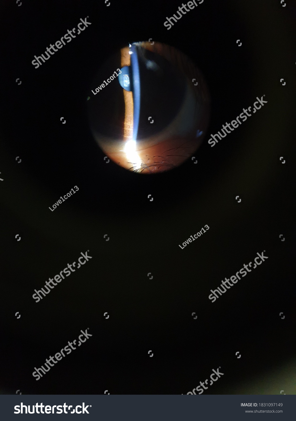 Normal Eye Slit Lamp Examination Stock Photo 1831097149 | Shutterstock