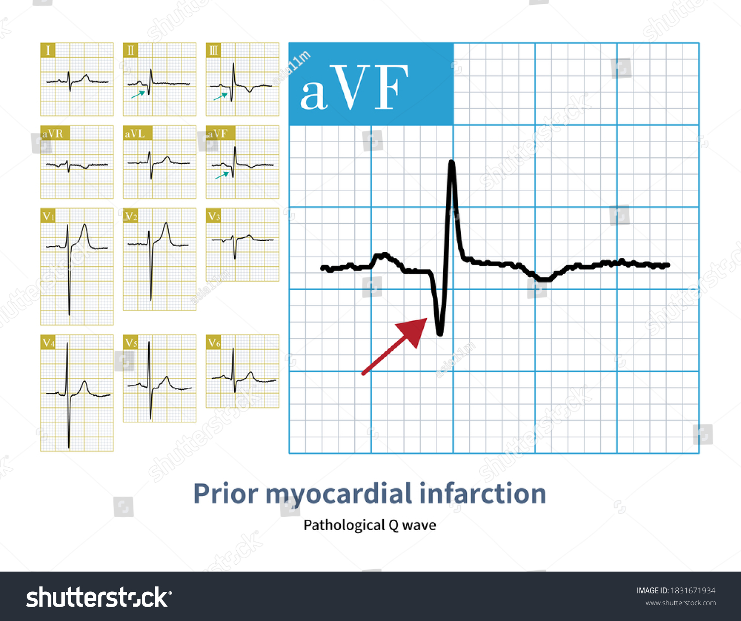 63yearold-male-who-suffered-myocardial-infarction-stockillustratie