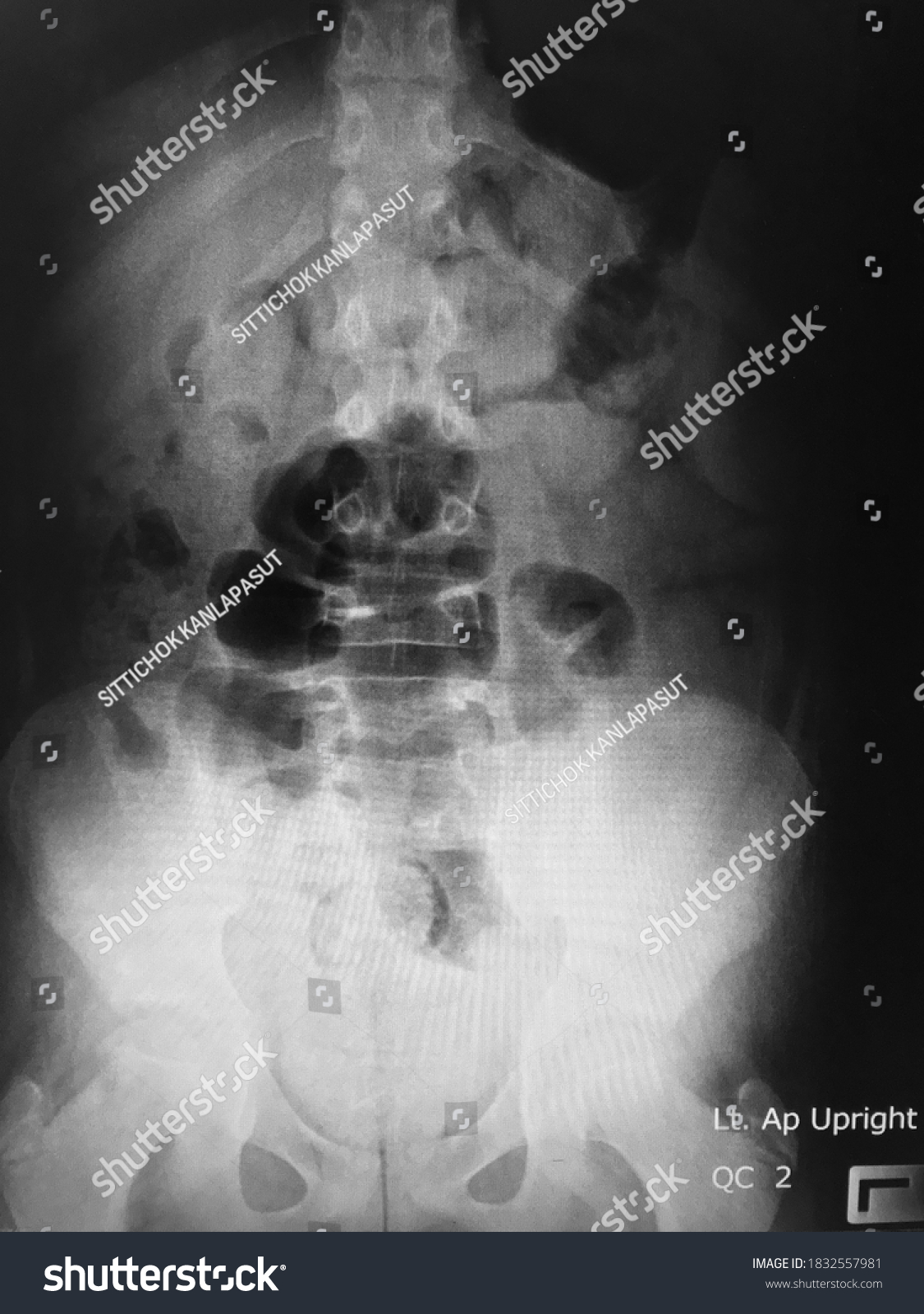 Film X Ray Abdomen Supine Position Stock Photo 1832557981 