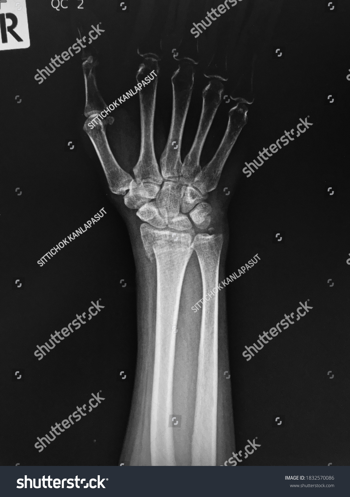 Film Xray Index Finger Hand Stock Photo 1832570086 | Shutterstock