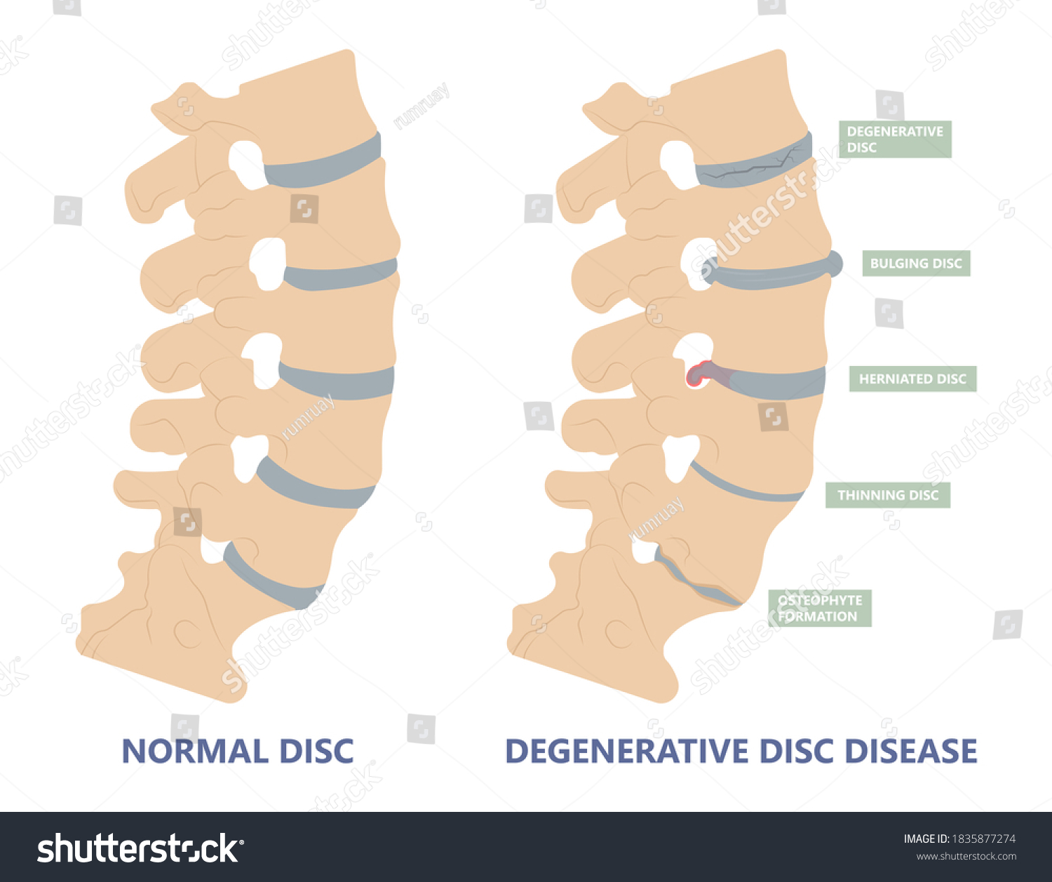 Artificial Disc Treatment Degenerative Disc Disease Stock Vector ...