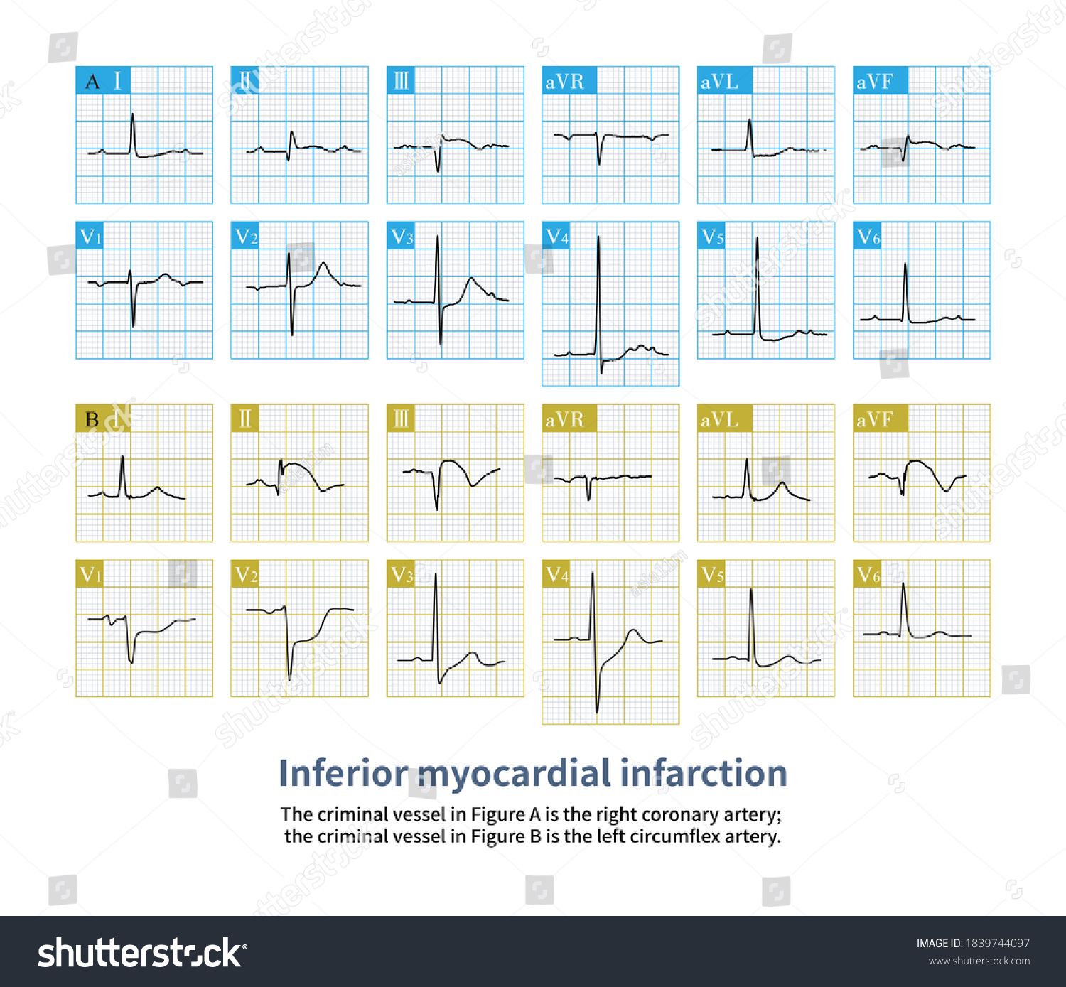 Case Inferior Myocardial Infarction Blood Vessel Stock Illustration ...