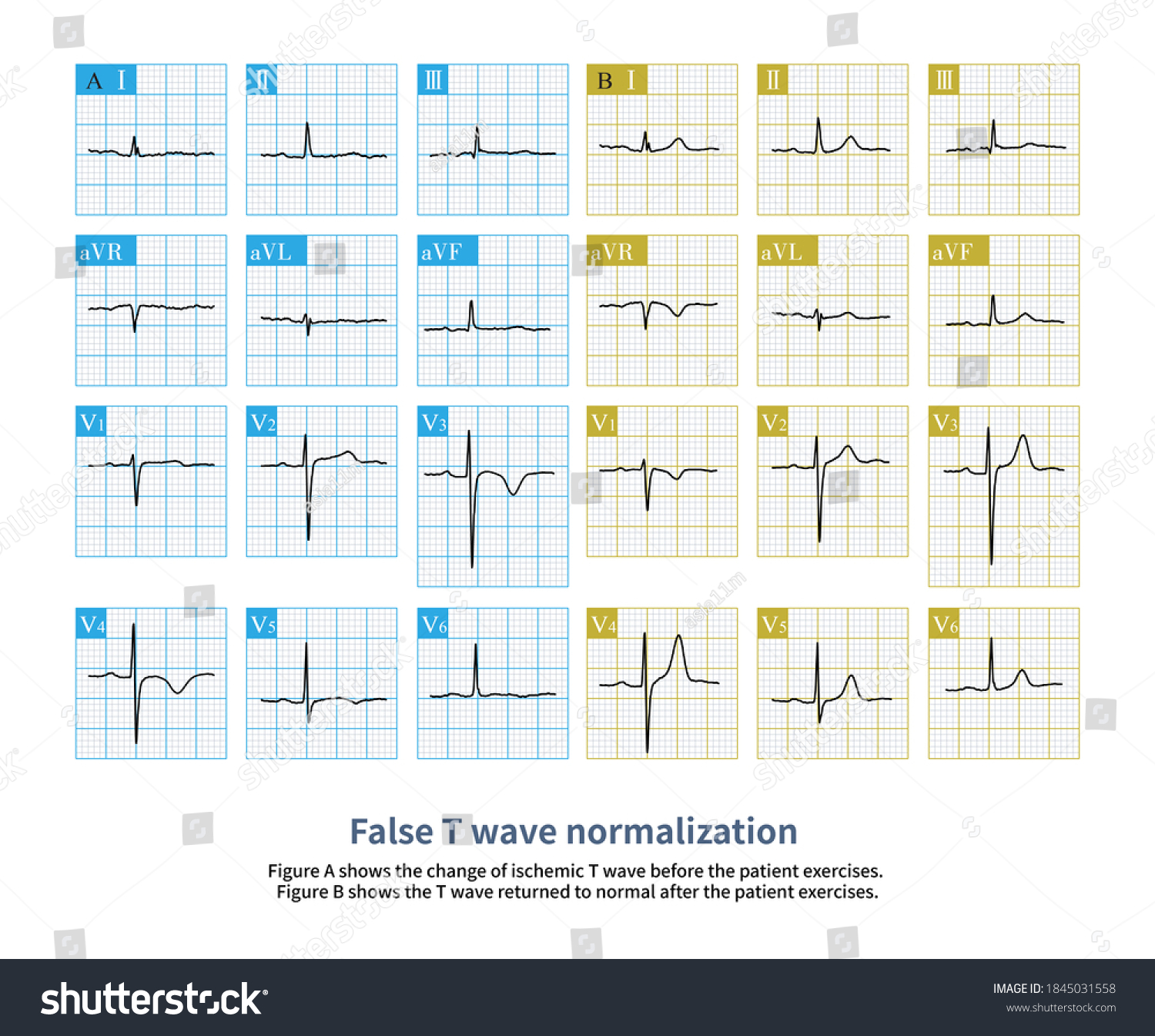 63yearold Male Abnormal Electrocardiogram Before Exercise Stock ...