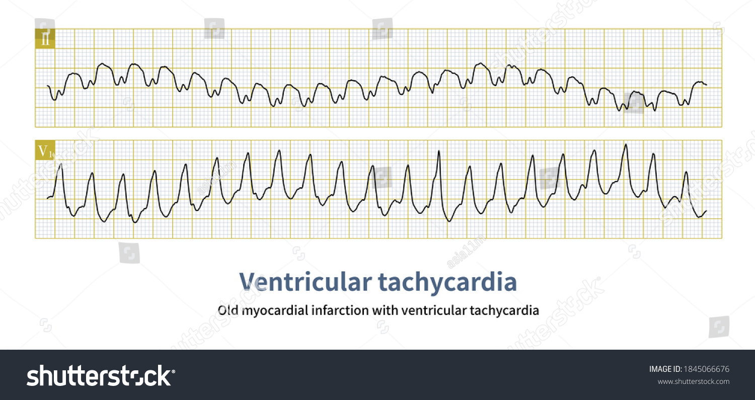 Patient Old Myocardial Infarction Developed Paroxysmal Stock ...