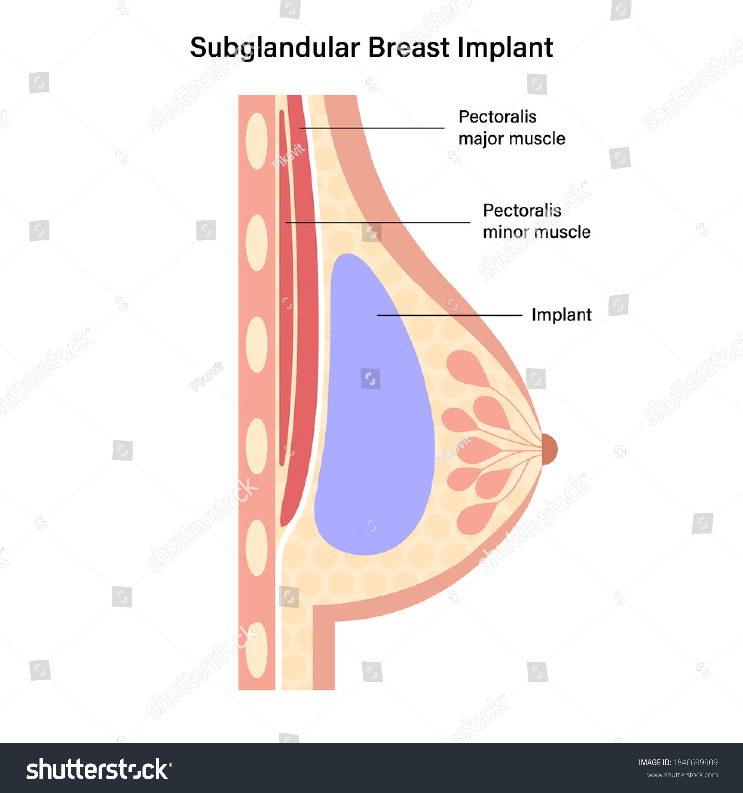 Breast Implant Female Silhouette Subglandular Placement Stock Vector Royalty Free 1846699909 7008