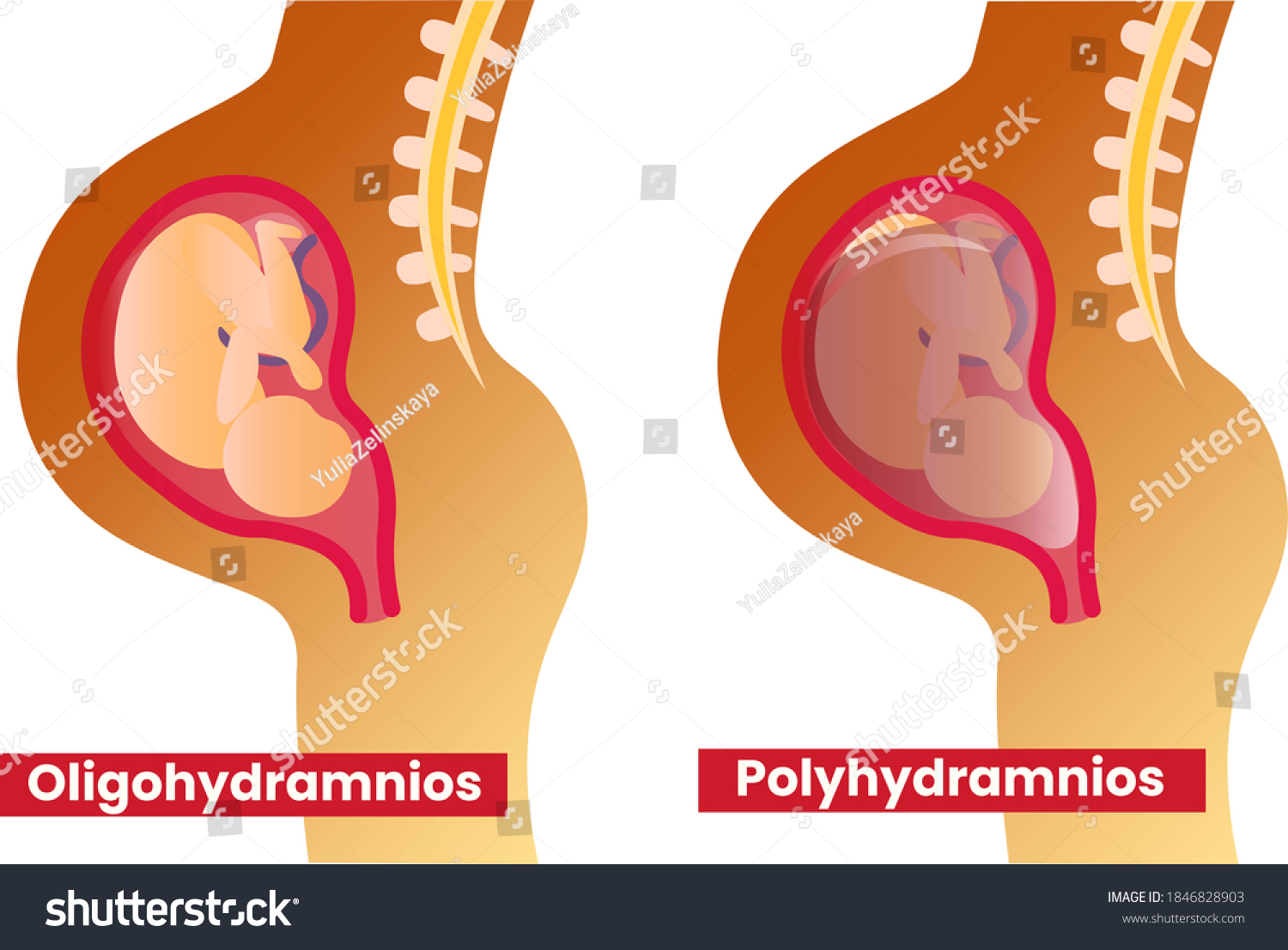 3-im-genes-de-polihidramnios-im-genes-fotos-y-vectores-de-stock