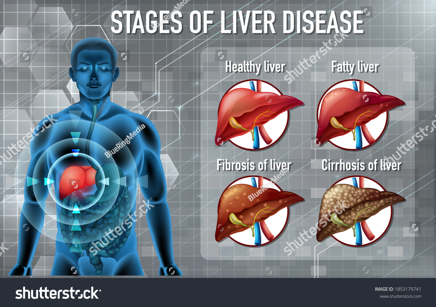 Stages Liver Disease Illustration Stock Vector (Royalty Free ...