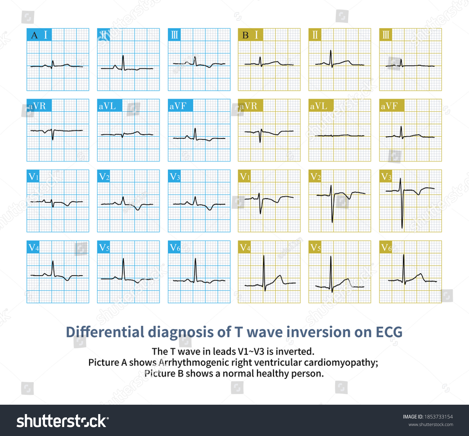 Inversion T Wave Chest Leads V1v3 Stock Illustration 1853733154 ...