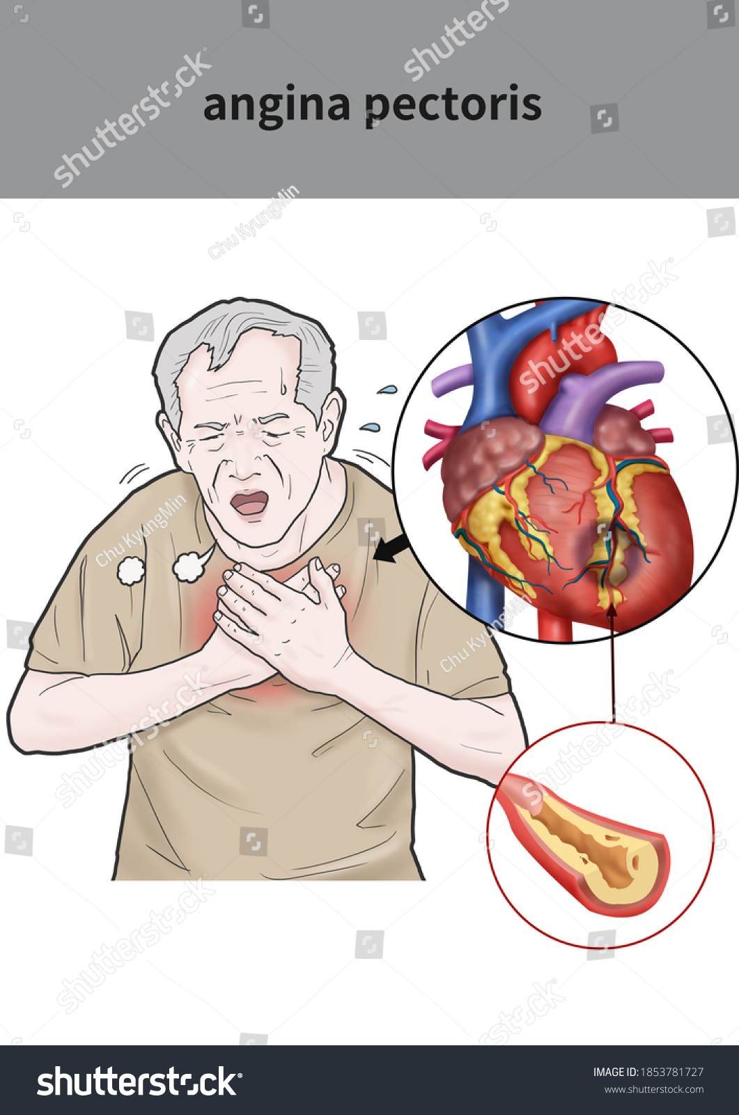 Ilustración médica para explicar angina de: ilustración de stock