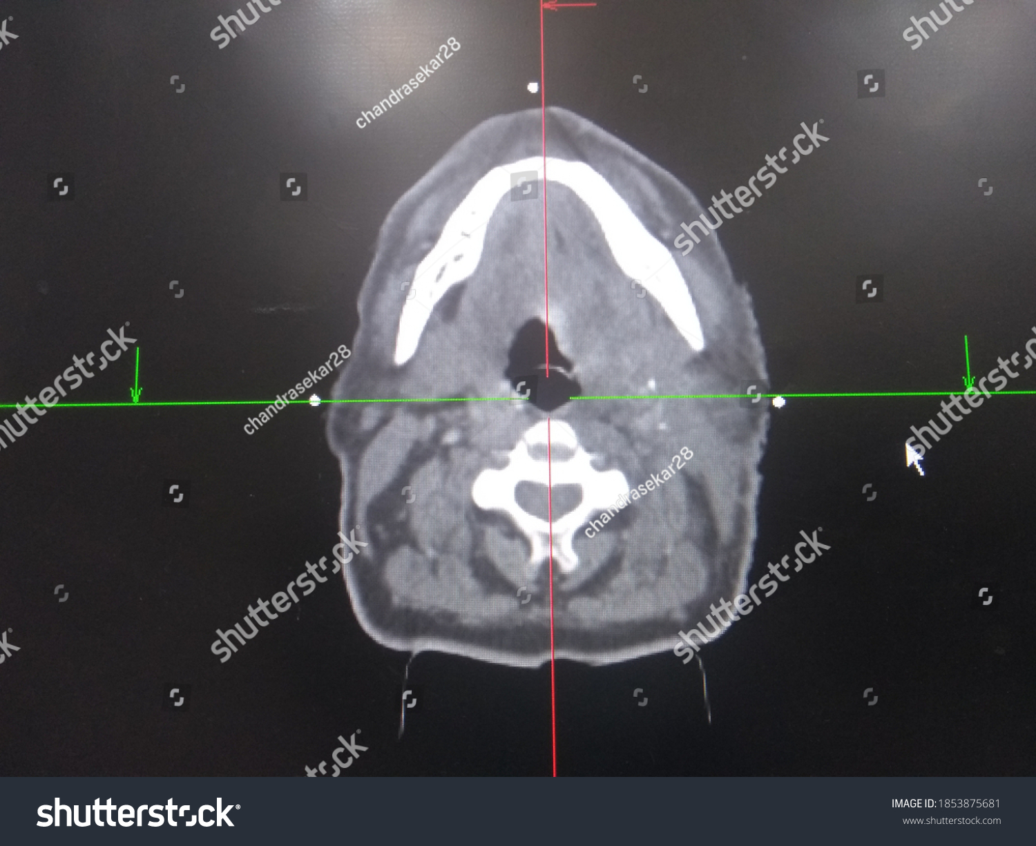 Ct Scan Slice Showing Fiducial Marker Stock Photo 1853875681 Shutterstock