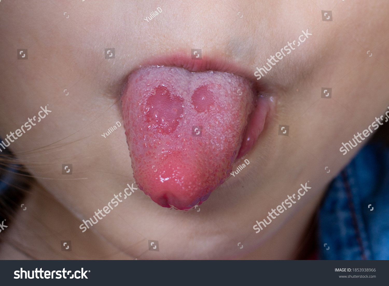 Aphthous Ulcers In Toddlers