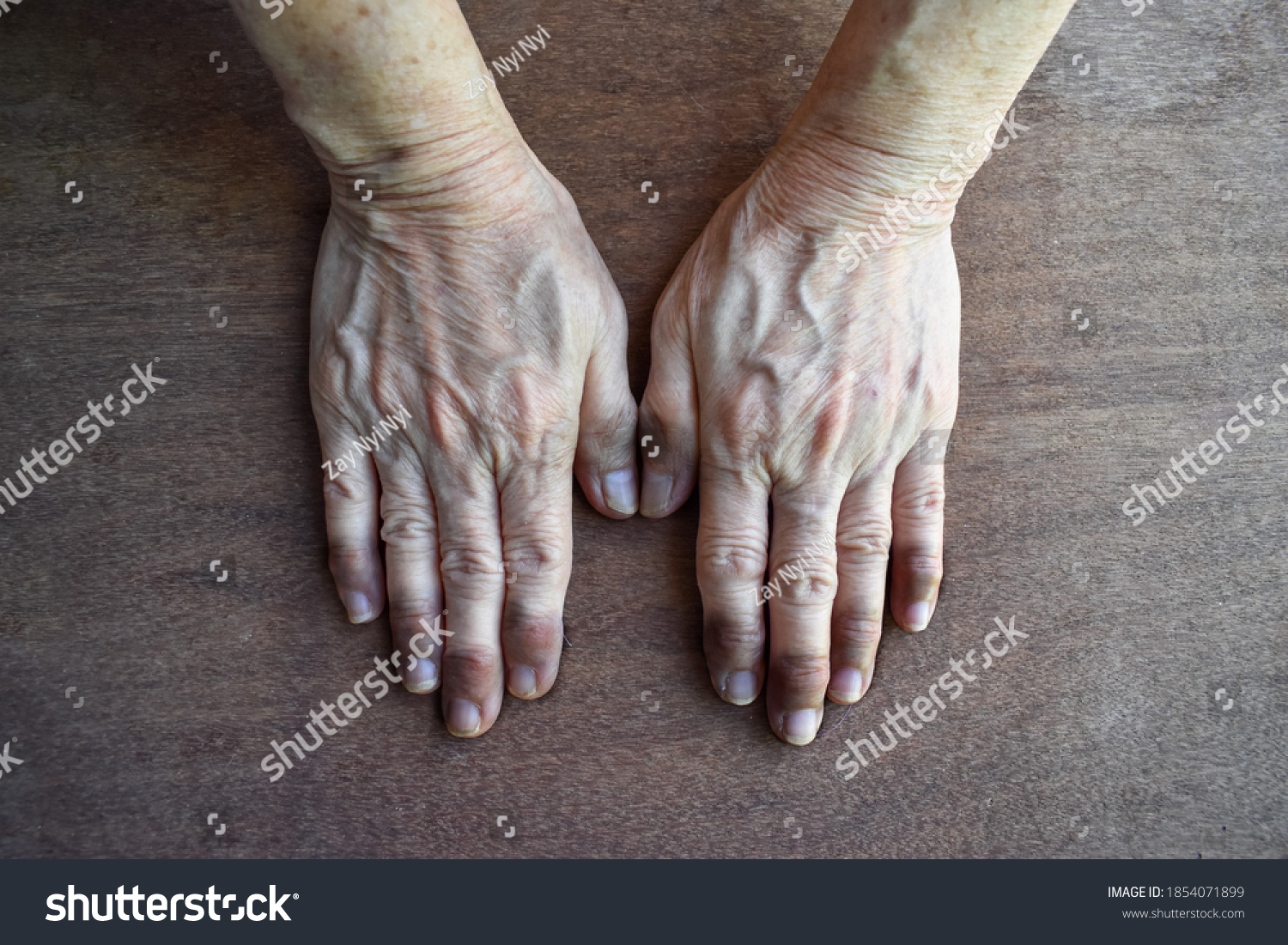 Cyanotic Hands Peripheral Cyanosis Blue Hands Stock Photo 1854071899 ...