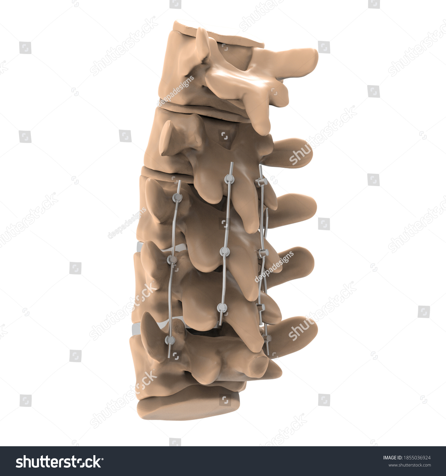 3d Illustration Spinal Fixation System Titanium Stock Illustration ...