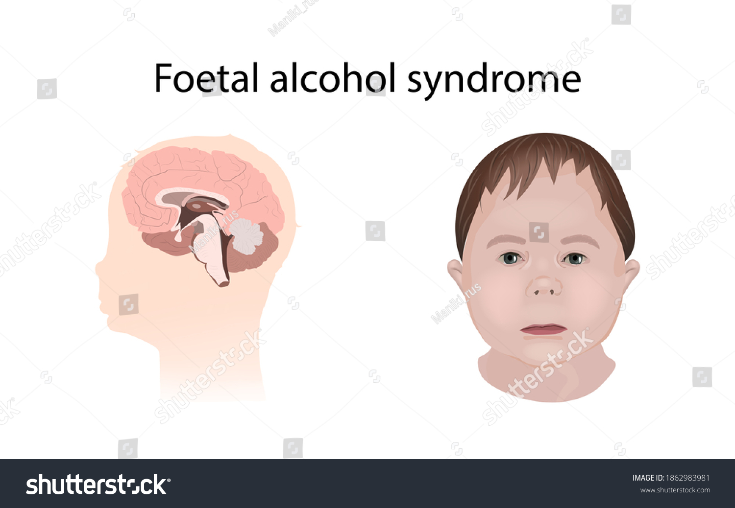 Illustration Showing Effects Foetal Alcohol Syndrome Stock Photo ...