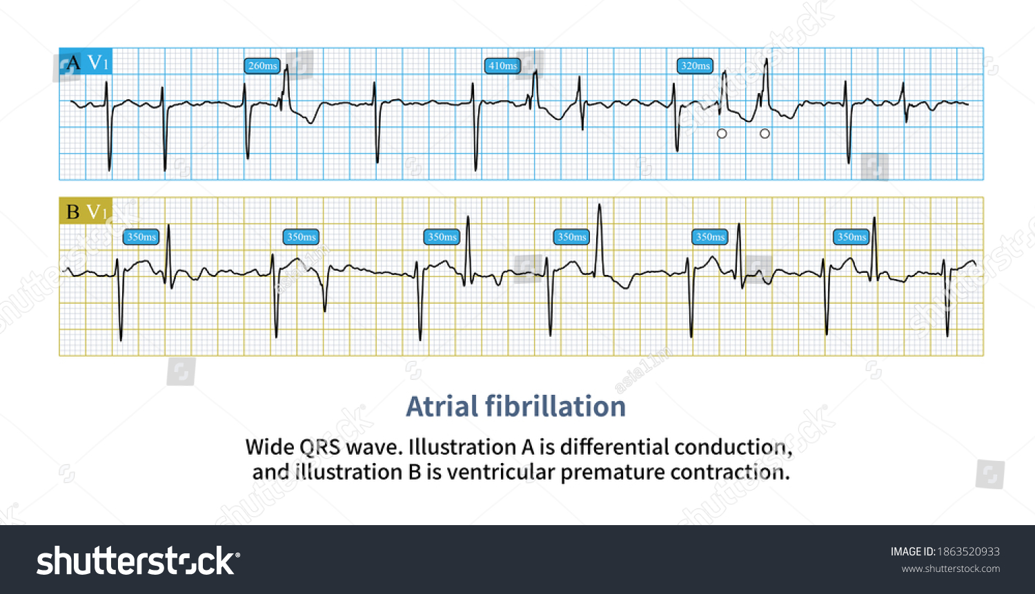 Wide Qrs Complex Atrial Fibrillation Needs Stock Illustration ...